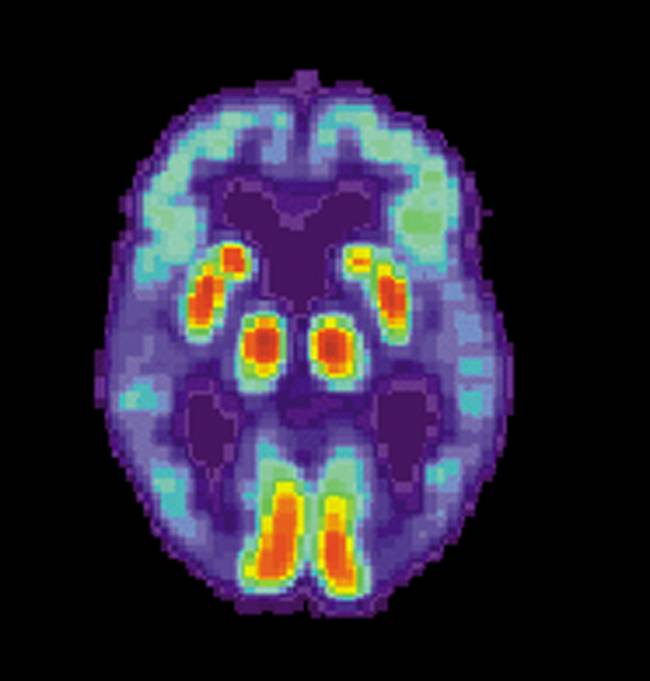 La población con alzheimer puede incrementarse un 75% en 25 años