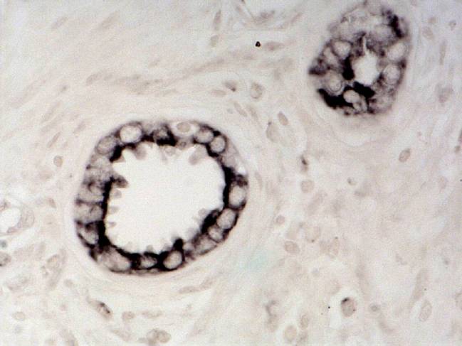 Las citoquinas pro-inflamatorias podrían mejorar el diagnóstico y el tratamiento del cáncer de próstata 