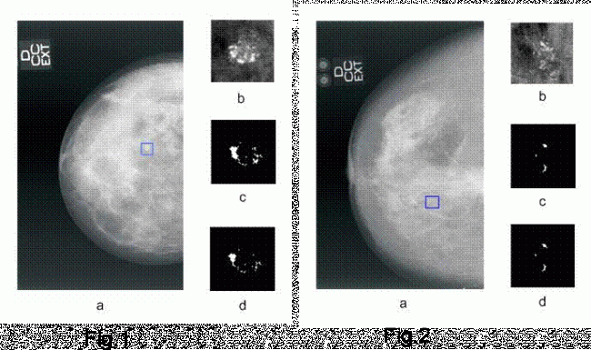 Las nuevas tecnologías aplicadas en la detección precoz del cáncer de mama