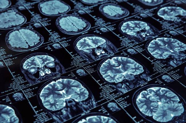  alzhéimer,  cerebro, beta amiloide 