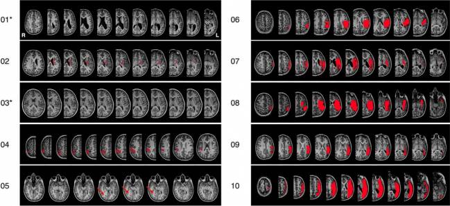 Los niños recuperan la funcionalidad cerebral del área afectada tras un ictus