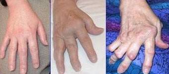 Los últimos fármacos para la artritis reumatoide son mejores que los antiinflamatorios estándar