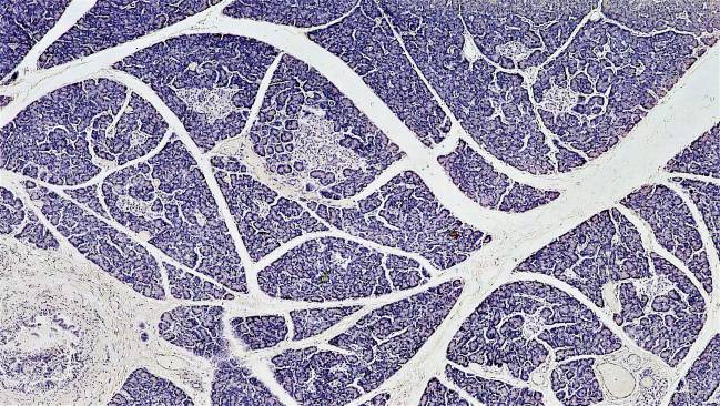 Más cerca del objetivo de tratar la diabetes tipo 1 con trasplantes de islotes pancreáticos