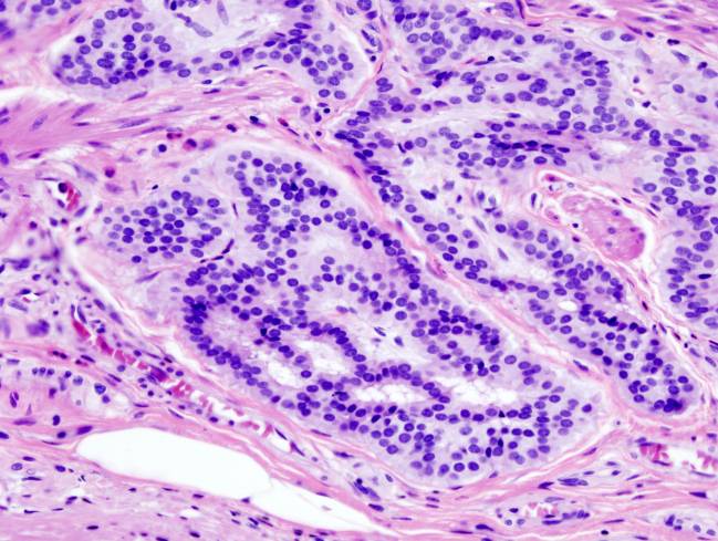 Nuevo biomarcador de respuesta a quimioterapia en cáncer de colon