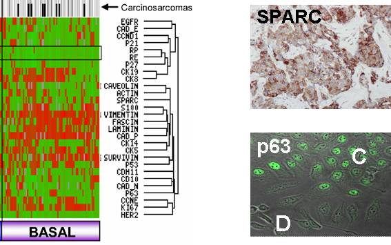 Nuevos marcadores tumorales en el carcinoma de mama de fenotipo basal