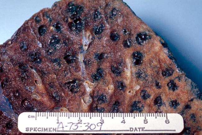 Sanidad trabaja en la Estrategia sobre la Enfermedad Pulmonar Obstructiva Crónica
