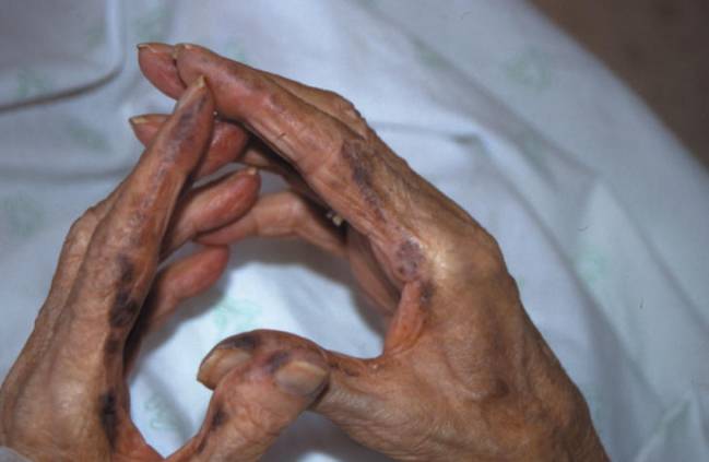 Se buscan pacientes españoles para investigar la enfermedad de los huesos negros 