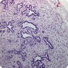 Se describe un nuevo mecanismo molecular que participa en la proliferación e invasión celular del cáncer de páncreas