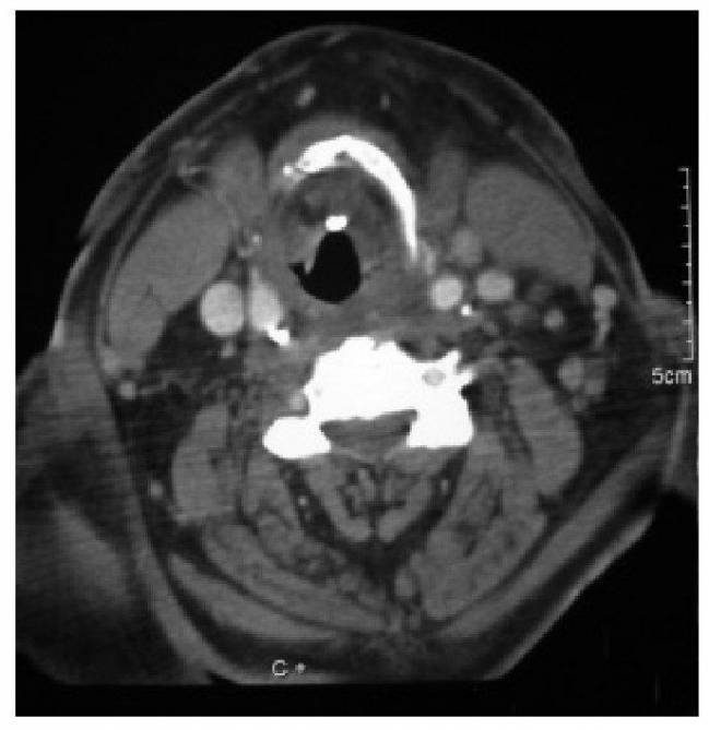 Un caso único de calcificación de la epiglotis