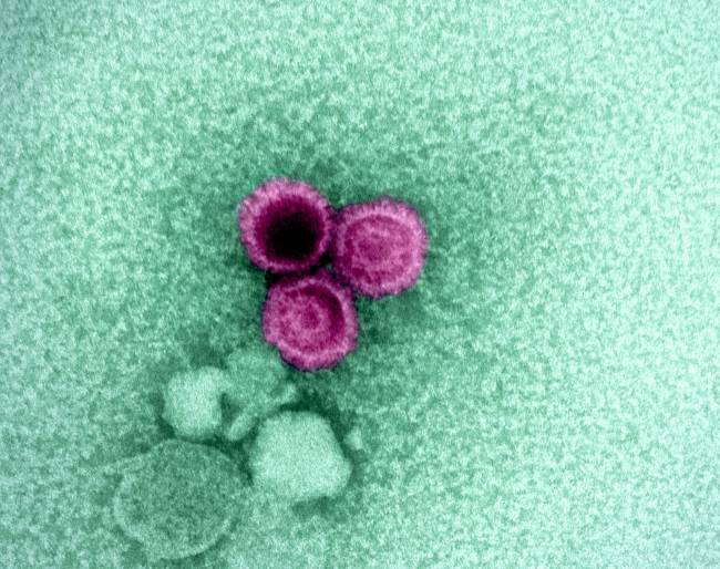 Un estudio confirma que el virus de Epstein-Barr de la mononucleosis puede causar esclerosis múltiple