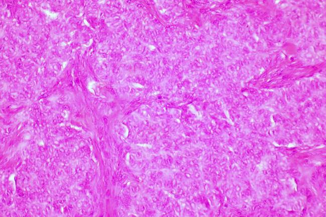 Un estudio español desvela el doble papel de una proteína en el cáncer de ovario