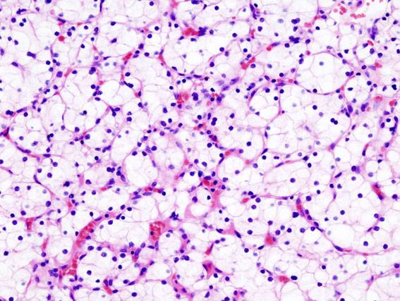 Un fármaco muestra buenos resultados en pacientes con cáncer de riñón avanzado de mal pronóstico