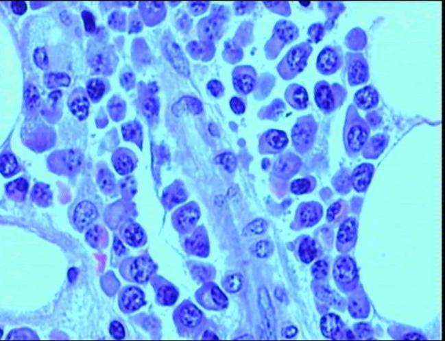 Un nuevo sistema detecta las recaídas en pacientes con mieloma múltiple