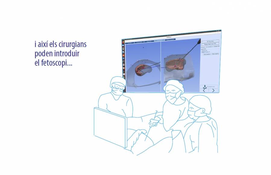 Un sistema de navegación quirúrgica pionero en el mundo para la cirugía fetal