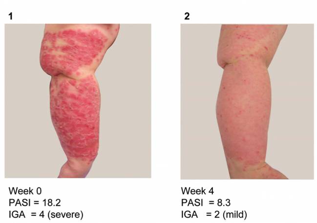 Un único anticuerpo combate la psoriasis, la inflamación de los ojos y la artritis