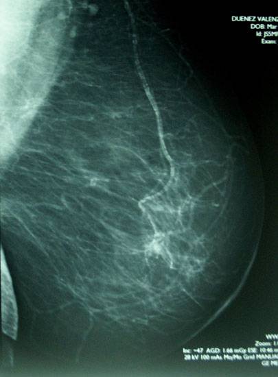 Una investigación genética abre las puertas al diseño de fármacos personalizados contra el cáncer de mama