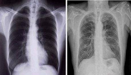 Una plataforma telemédica controla desde casa a personas enfermas de pulmón