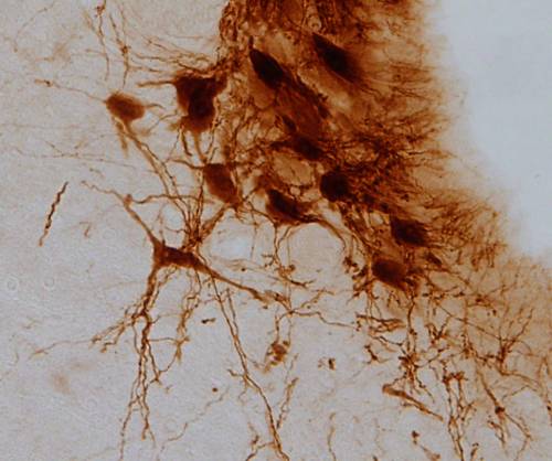 El dolor diabético y la ansiedad comparten un mecanismo cerebral común