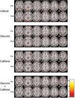 El contraste muestra las áreas con una actividad cerebral significativa. Imagen: UB