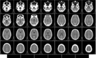 Tomografía Cerebral