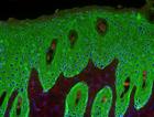 piel hiperproliferativa