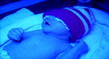 En la imagen, un neonato recibe fototerapia.