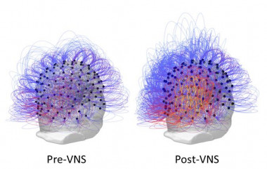 <p>Flujo de información a través de los electrodos antes y después de la estimulación del nervio vago (a la derecha, post-VNS). A la derecha, los colores cálidos (amarillo y rojo) indican un aumento en la conectividad entre las regiones parietales posteriores. / Corazzol et al.</p>