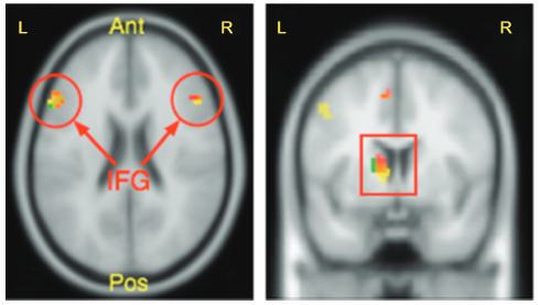 cerebro