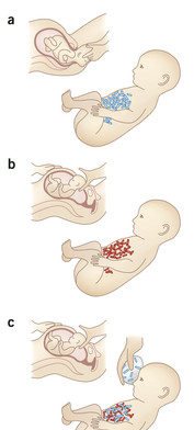 Diferencias en el microbioma según el tipo de parto./ Kim Caesar/Nature Publishing Group