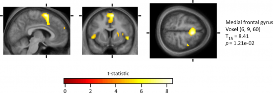 En el experimento de Zeki y Romaya, varias áreas del cerebro se activan de manera especial cuando los voluntarios del experimento miraban las caras de las personas odiadas.