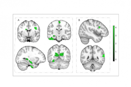 Los-ninos-con-mayor-capacidad-aerobica-tienen-mas-materia-gris-en-el-cerebro_image_380