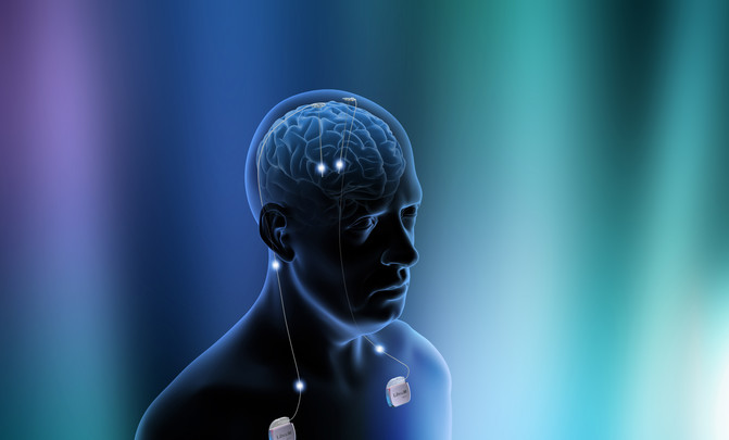 Esquema del implante de un dispositivo de estimulación cerebral profunda. / Health Science Center