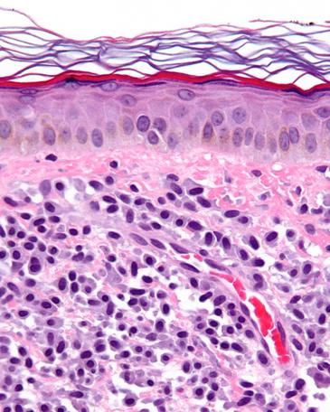 Micrografía de una mastocitosis. Biopsia de piel. Imagen: Wikipedia 