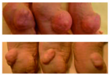 Ejemplo de tres tumores de colon (imagen arriba) cuyo crecimiento fue inhibido (imagen debajo) por la molécula de ARN (acido ribonucleico) identificada que actúa como antioncogén. Imagen: IDIBELL  