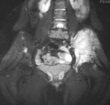Nuevo hallazgo en las bases genéticas del sarcoma de Ewing