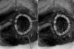 Nuevo sistema para tratar las insuficiencias valvulares cardiacas
