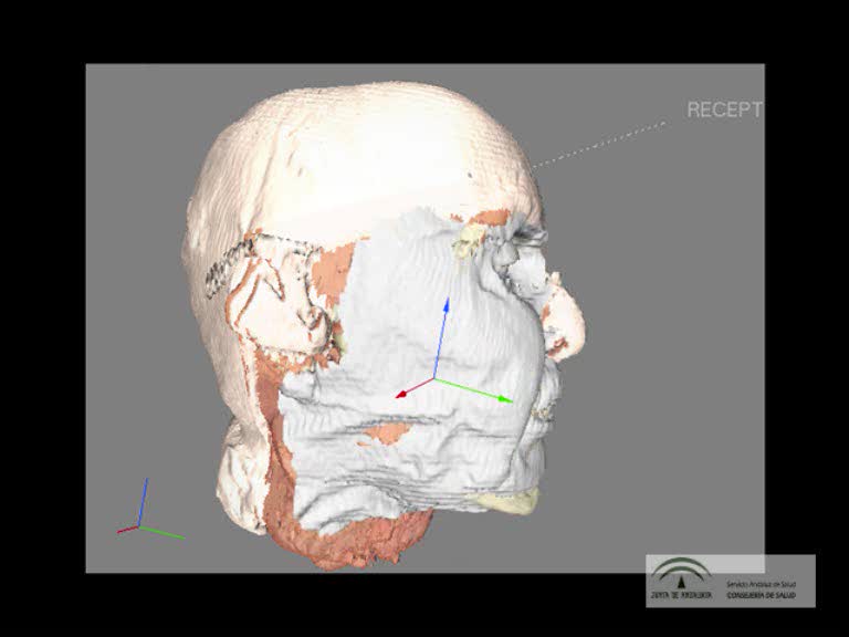 Previsualización de Explican la planificación quirúrgica del trasplante de rostro de Sevilla