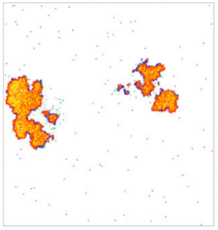 Una población de células cancerígenas (rojo y amarillo) mientra son 'lisadas' (se rompe su membrana celular) por diversos grupos de linfocitos T citotóxicos (azul). / URJC <p>Una población de células cancerígenas (rojo y amarillo) mientra son