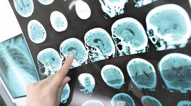 Un médico observa un TAC craneal. / Fotolia