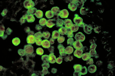 <p>Histopatologia de la meningoencefalitis amébica. / Wikimedia Commons.</p>