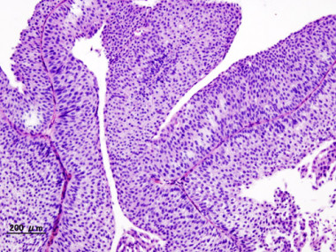 Histopatología de carcinoma urotelial de la vejiga urinaria. / Wikipedia