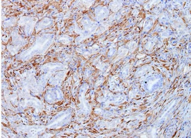 Células tumorales de cáncer de páncreas del modelo Kras del CNIO, mostrando en color marrón la expresión de Galectina-1. / IMIM