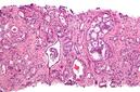 Descubren el talón de Aquiles del cáncer de próstata neuroendocrino