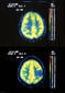 Comparación de un cerebro normal, arriba, y otro afectado por un astrocitoma, abajo, tomada de una tomografía axial computorizada (TAC).