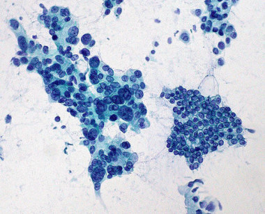 <p>Adenocarcinoma de páncreas / <a href="http://www.flickr.com/photos/euthman/322383640/" target="_blank">Ed Uthman</a></p>