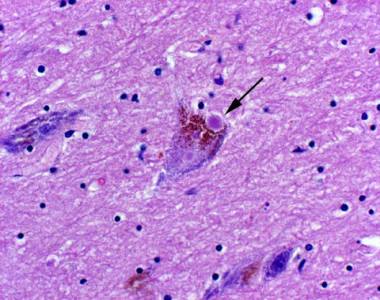 <p>En la imagen, una neurona con cuerpos de Lewy, las estructuras neurotóxicas características de un cerebro con párkinson. / <a href="http://www.agenciasinc.es/Multimedia/Fotografias/Dos-claves-en-el-rompecabezas-del-parkinson" target="_blank">UCSF</a></p>