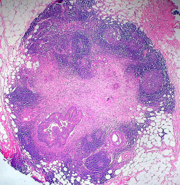 <p>Cada año se diagnostican más de 25.000 casos nuevos de cáncer de colon en España. Foto: Euthman.</p>