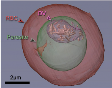 Tomografía donde se ve el parásito (marcado en verde) dentro del glóbulo rojo (RBC marcado en rojo). En el parásito se observa la vacuola digestiva (DV) donde se concentran los cristales de hemozoína formados. / Sincrotrón ALBA