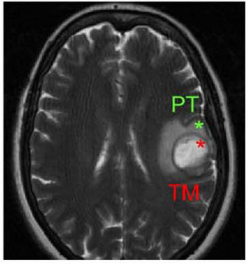 <p>Cerebro afectado por un glioblastoma en el que se distingue la zona central de la masa tumoral (TM) de la zona periférica tumoral (PT). / Atanasio Pandiella/DiCYT.</p>