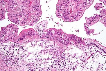 Identifican los genes vinculados con los cánceres de ovario más mortales